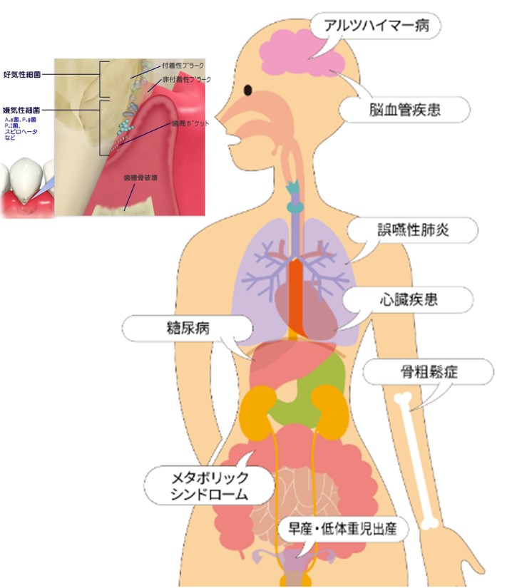 歯周病って全身疾患と関係あるって聞いたのですが本当ですか