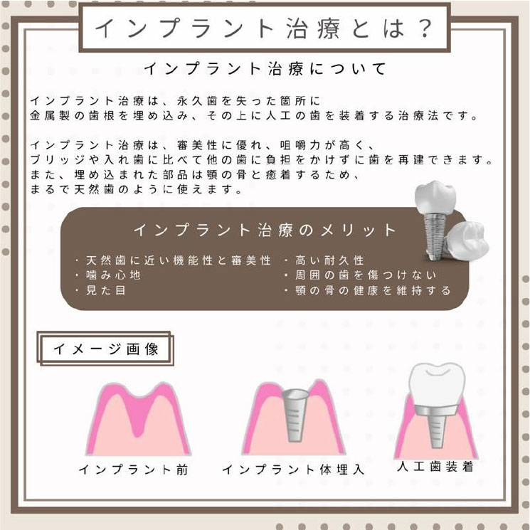 インプラント治療とは｜やまのうち歯科医院