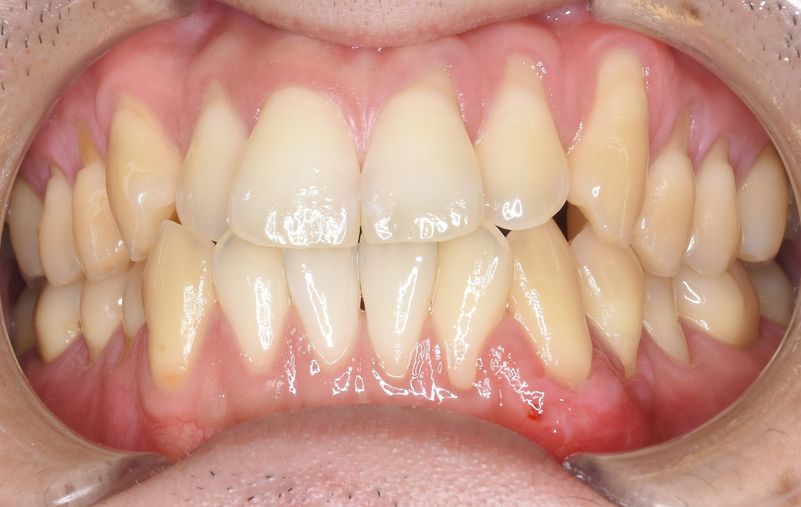 case4-a