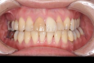 ホワイトニング