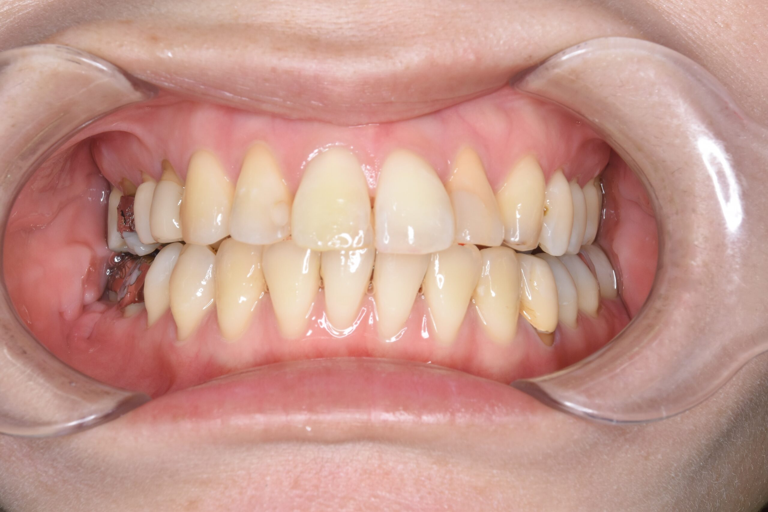 ホワイトニング