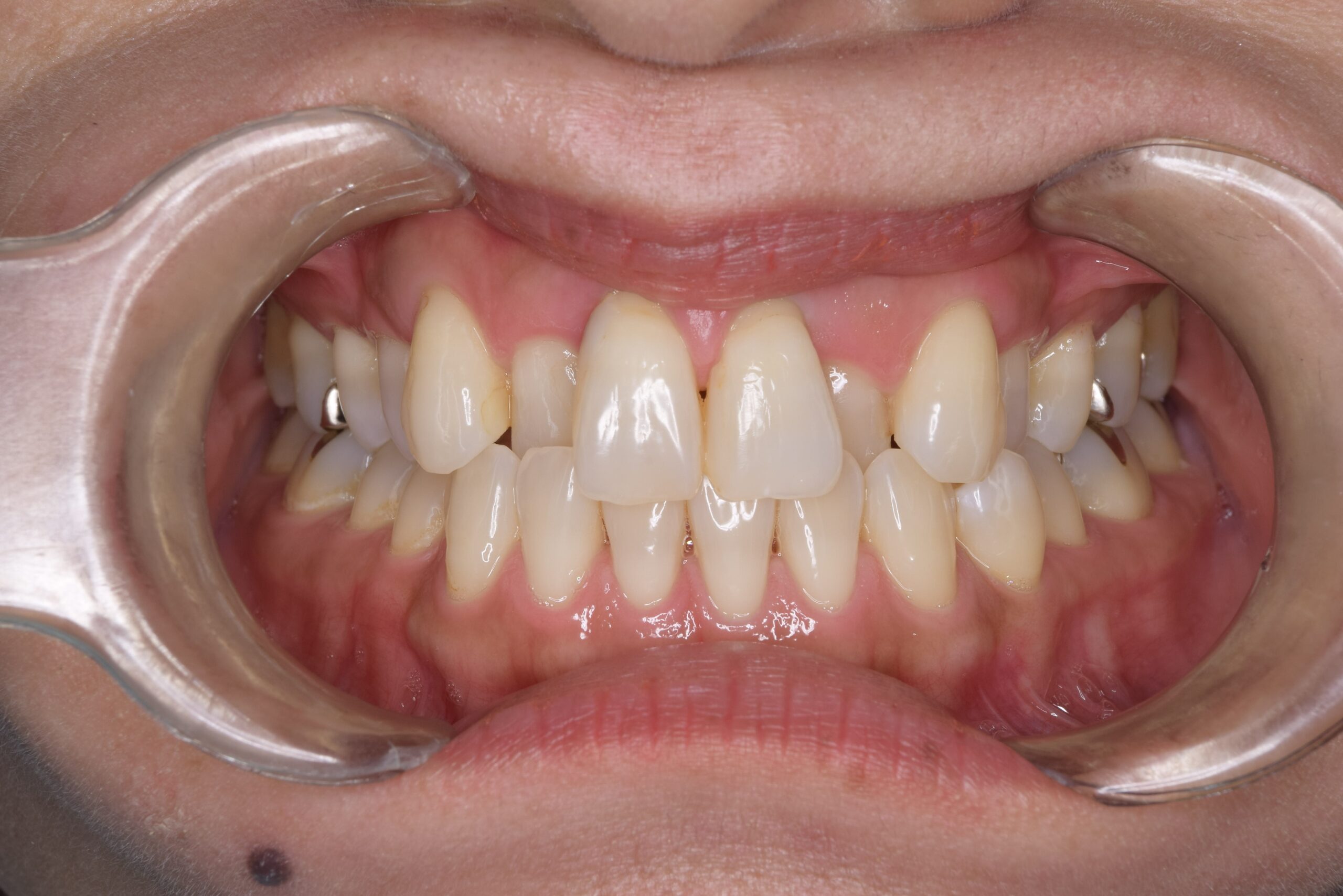 case11-b