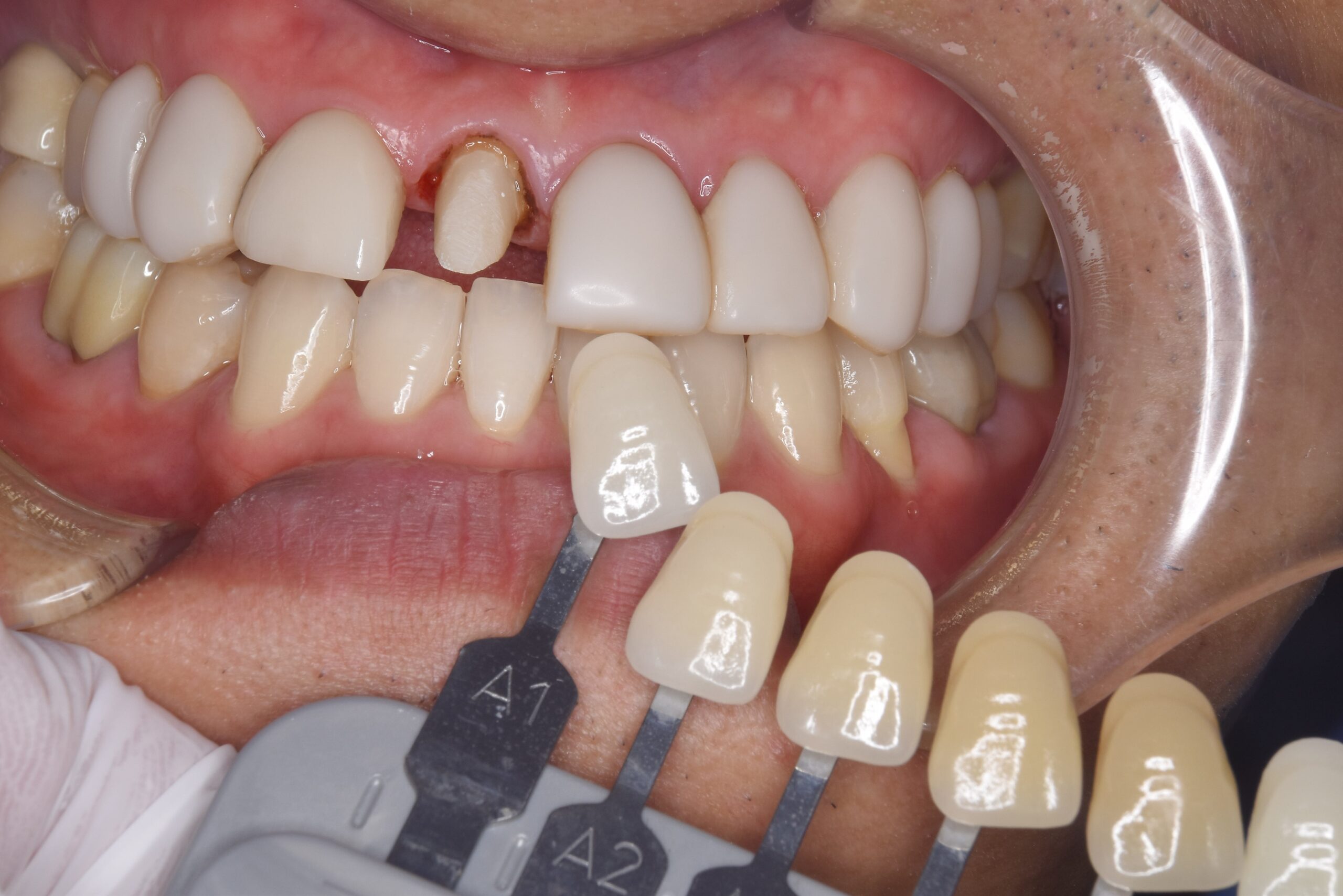 case12-b