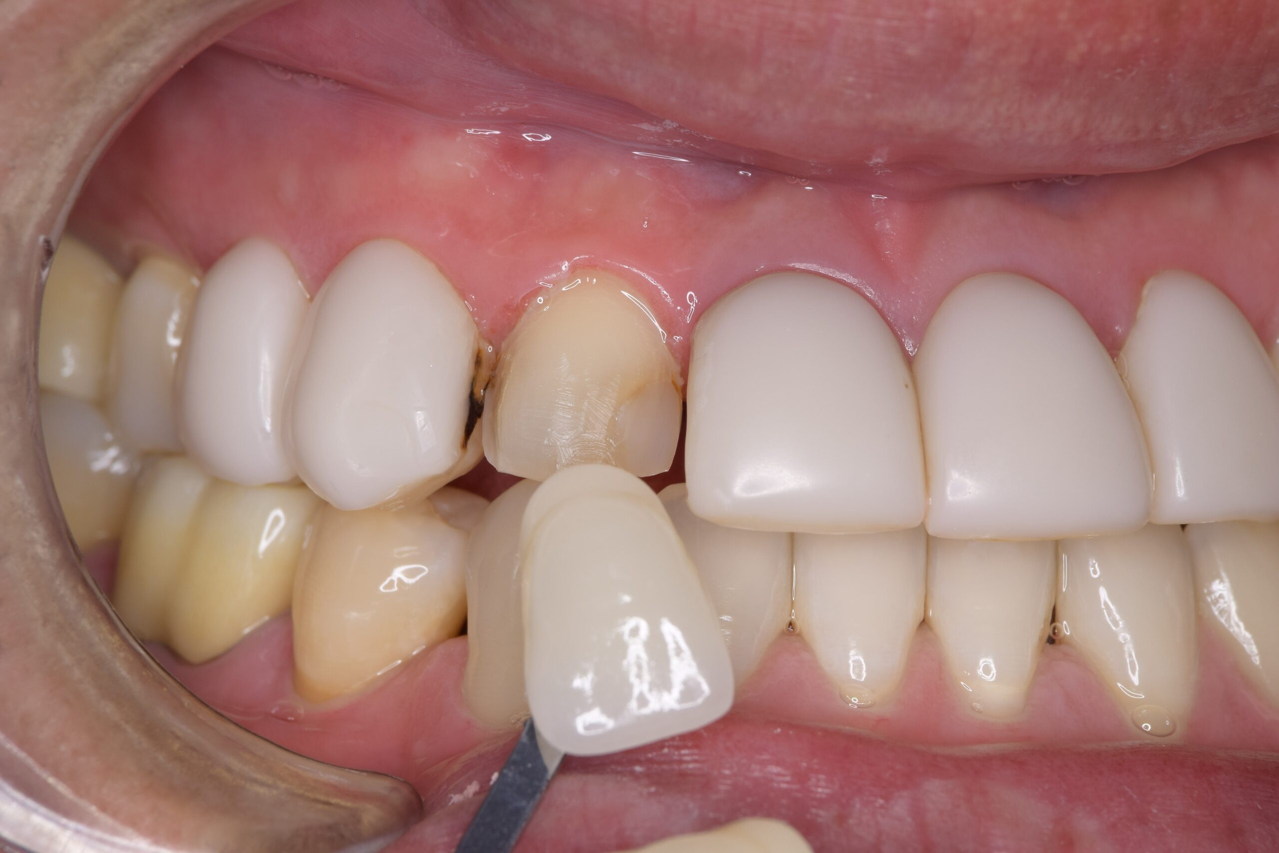 case13-b
