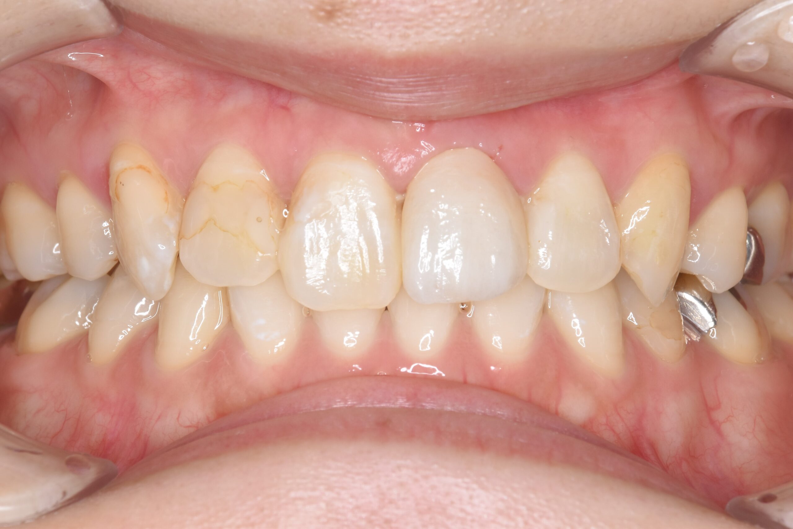case14-a