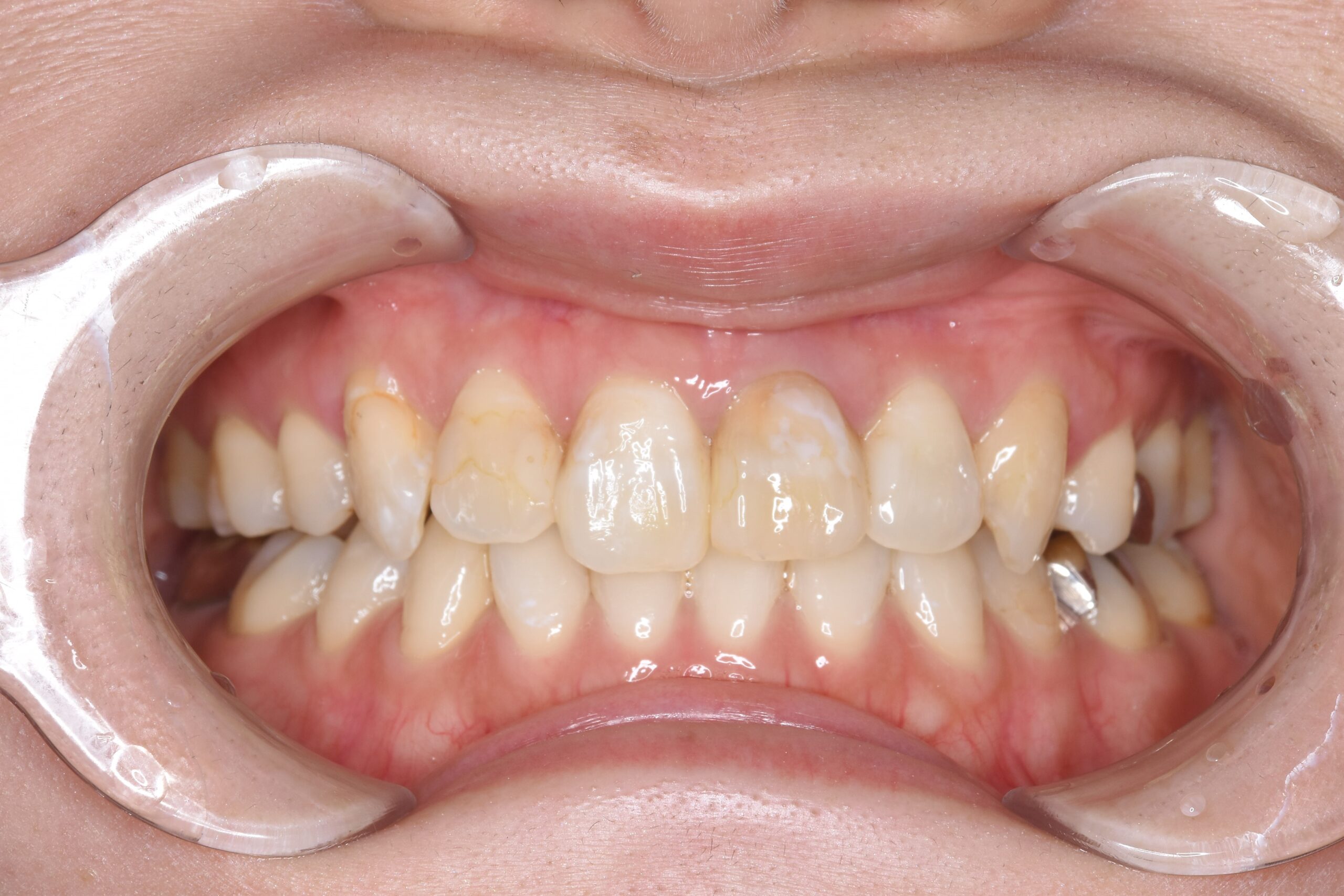 case14-b