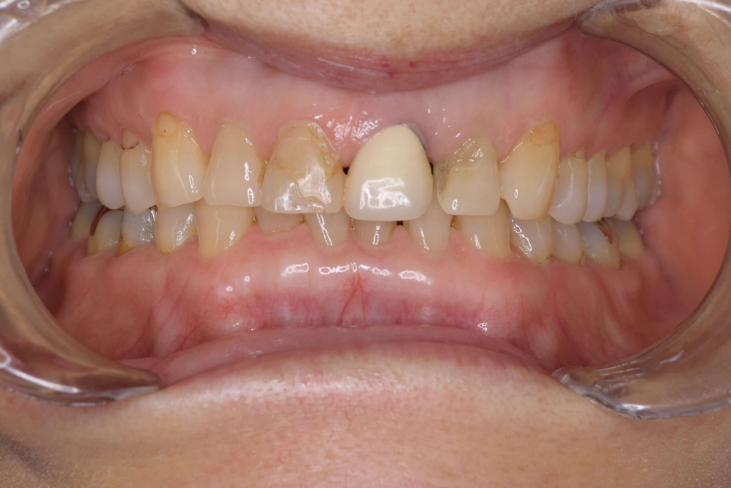 case16-b