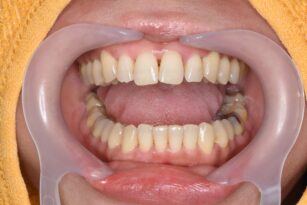 case17-b