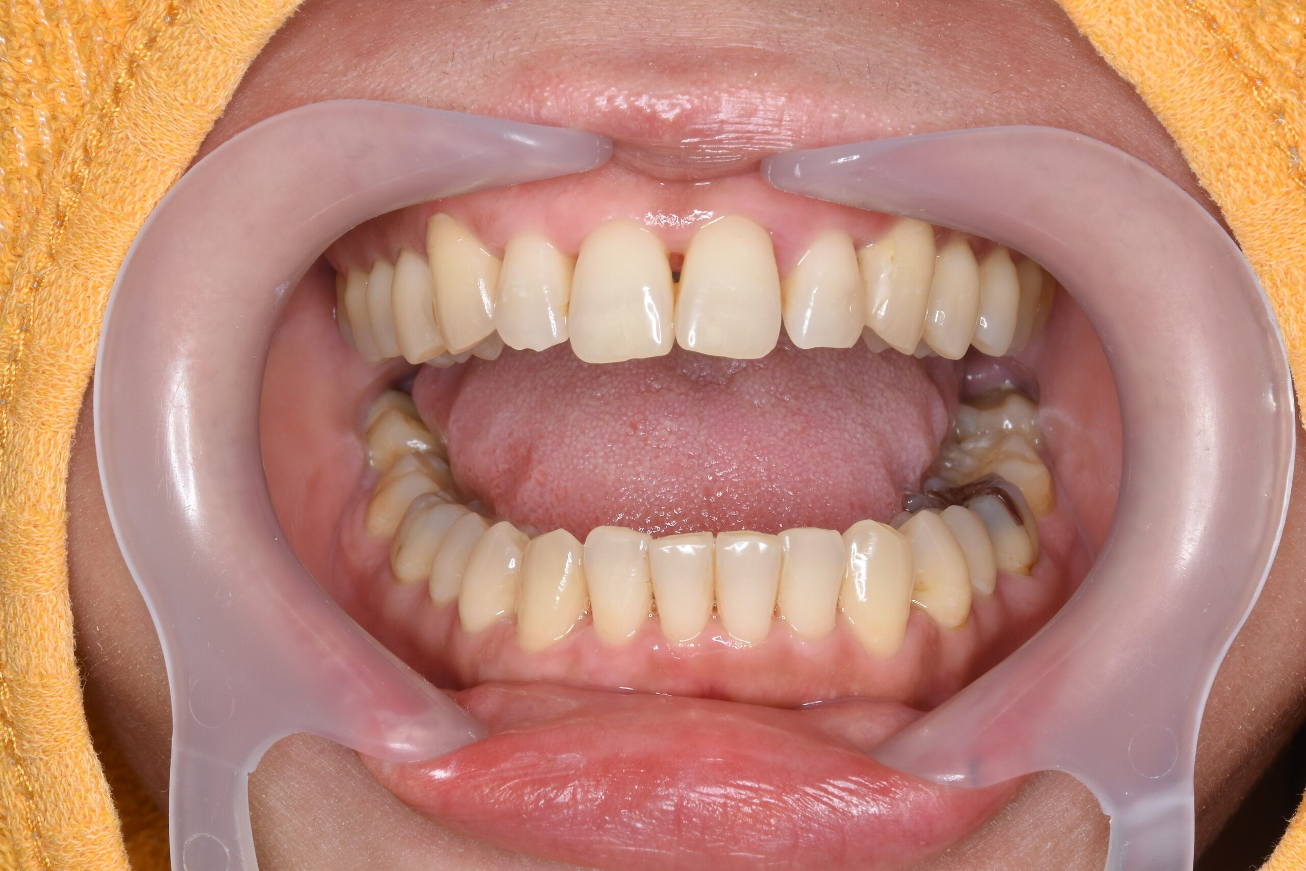 case17-b