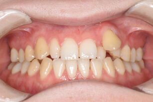 case18-b