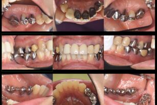 case22-thum