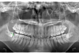 case23-b