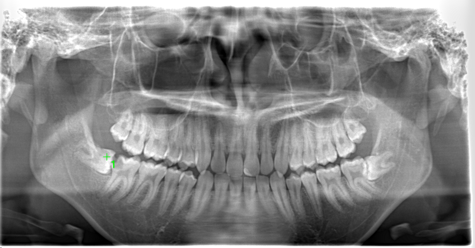 case23-b