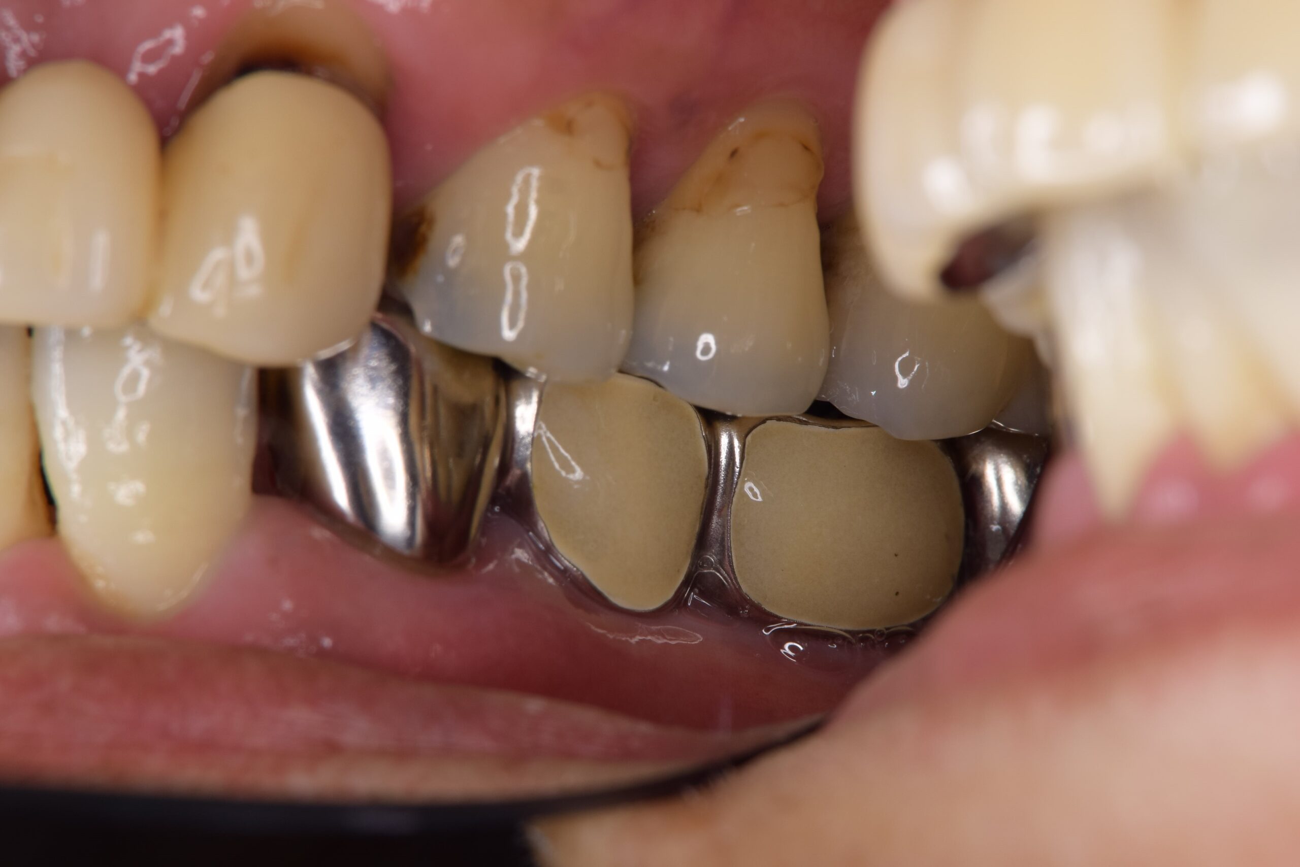 ジルコニアポーセレン