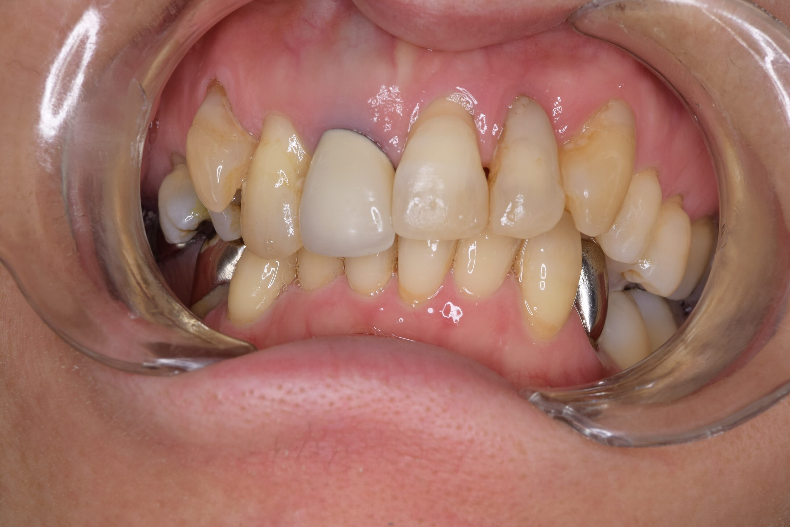 ジルコニアポーセレン