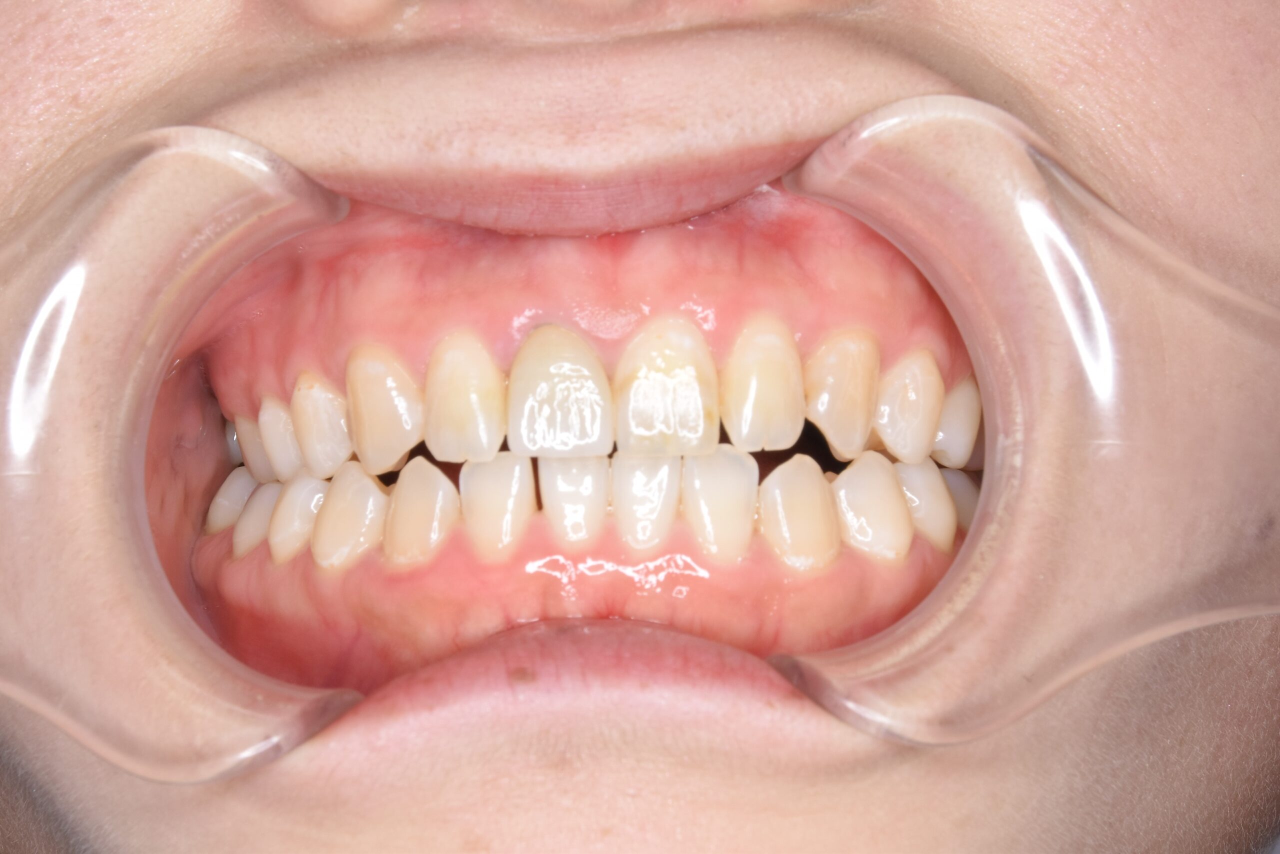 ホワイトニング