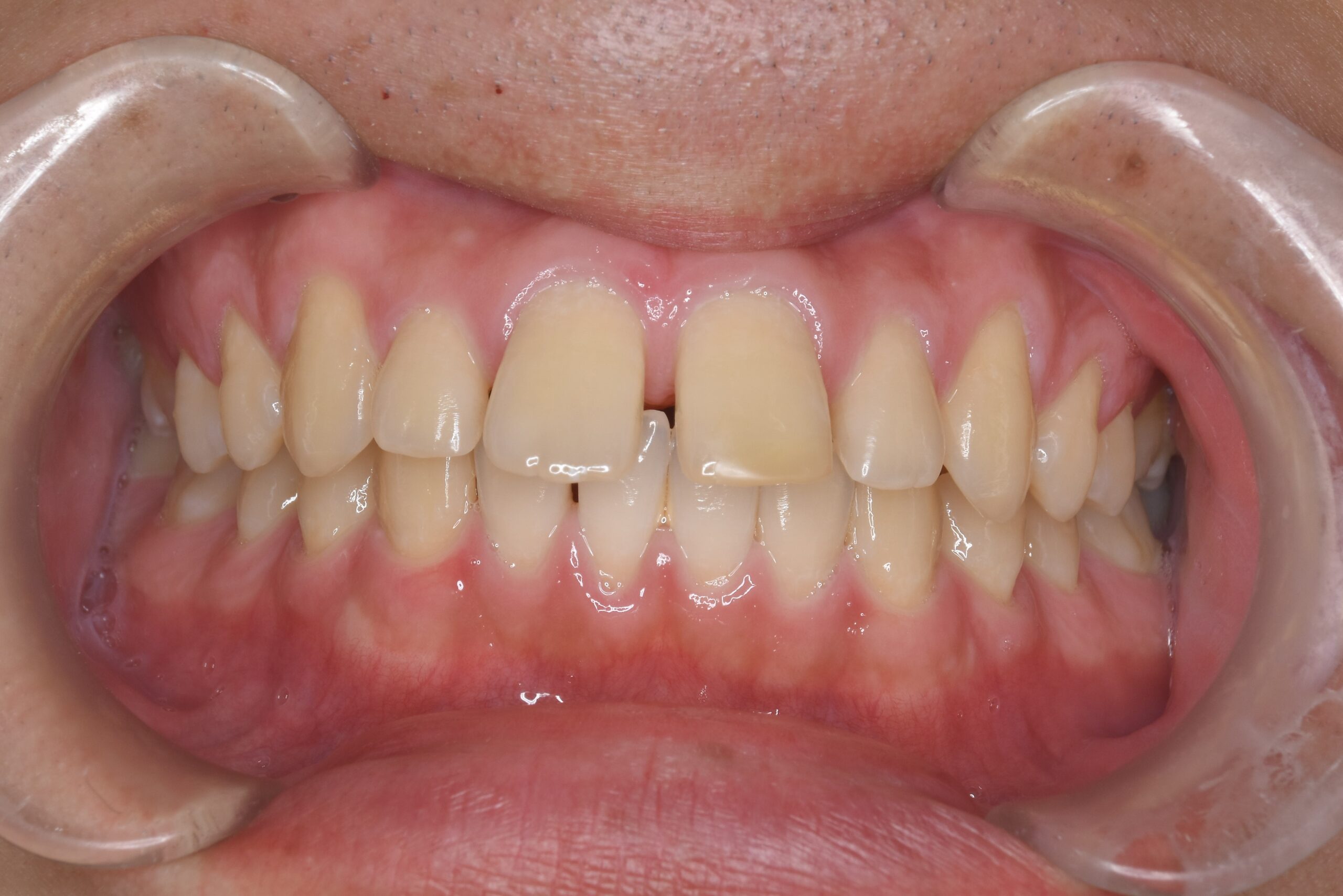 やまのうち歯科医院　宇都宮　歯医者　歯周病　インプラント　ホワイトニング　矯正　1