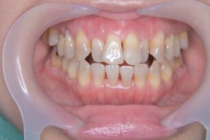 やまのうち歯科医院　宇都宮　歯医者　歯周病　インプラント　ホワイトニング　矯正　3