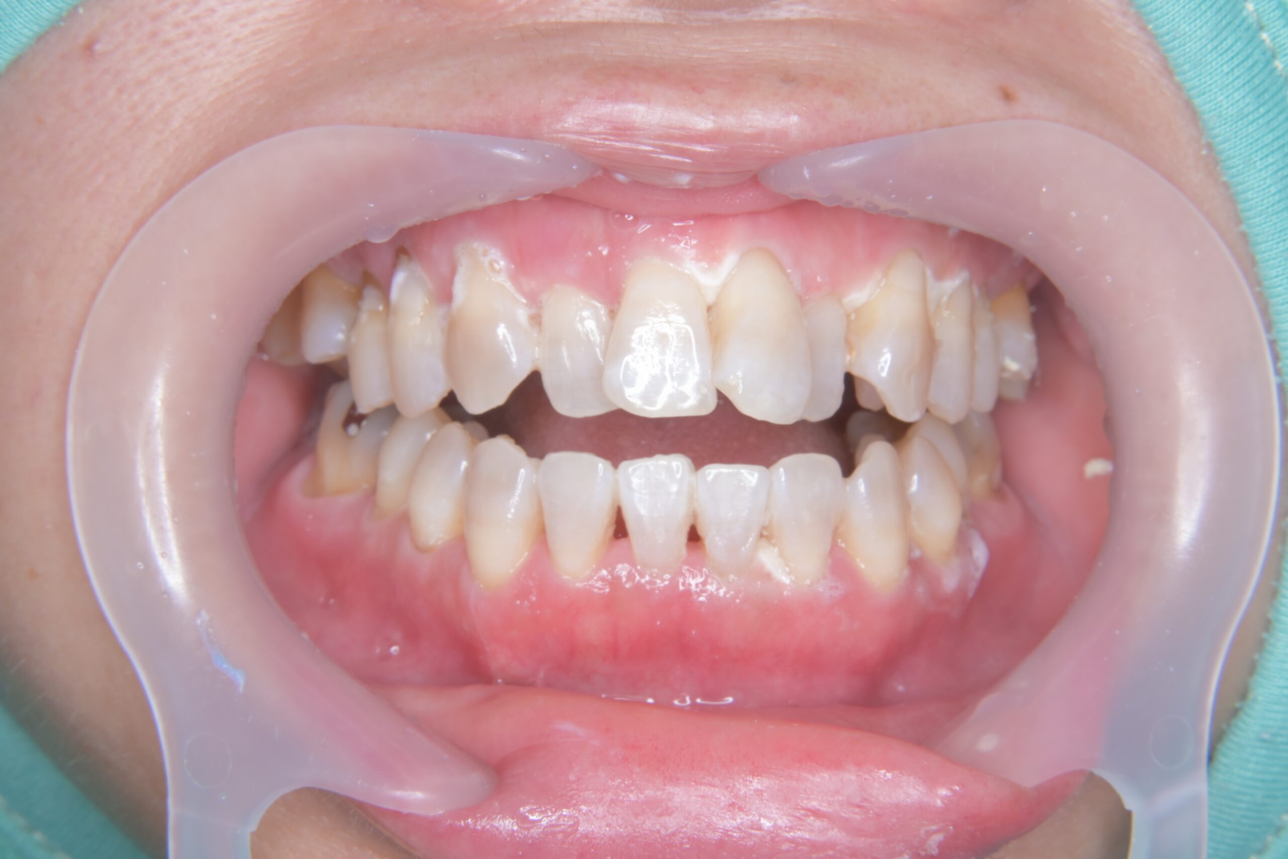 やまのうち歯科医院　宇都宮　歯医者　歯周病　インプラント　ホワイトニング　矯正　4