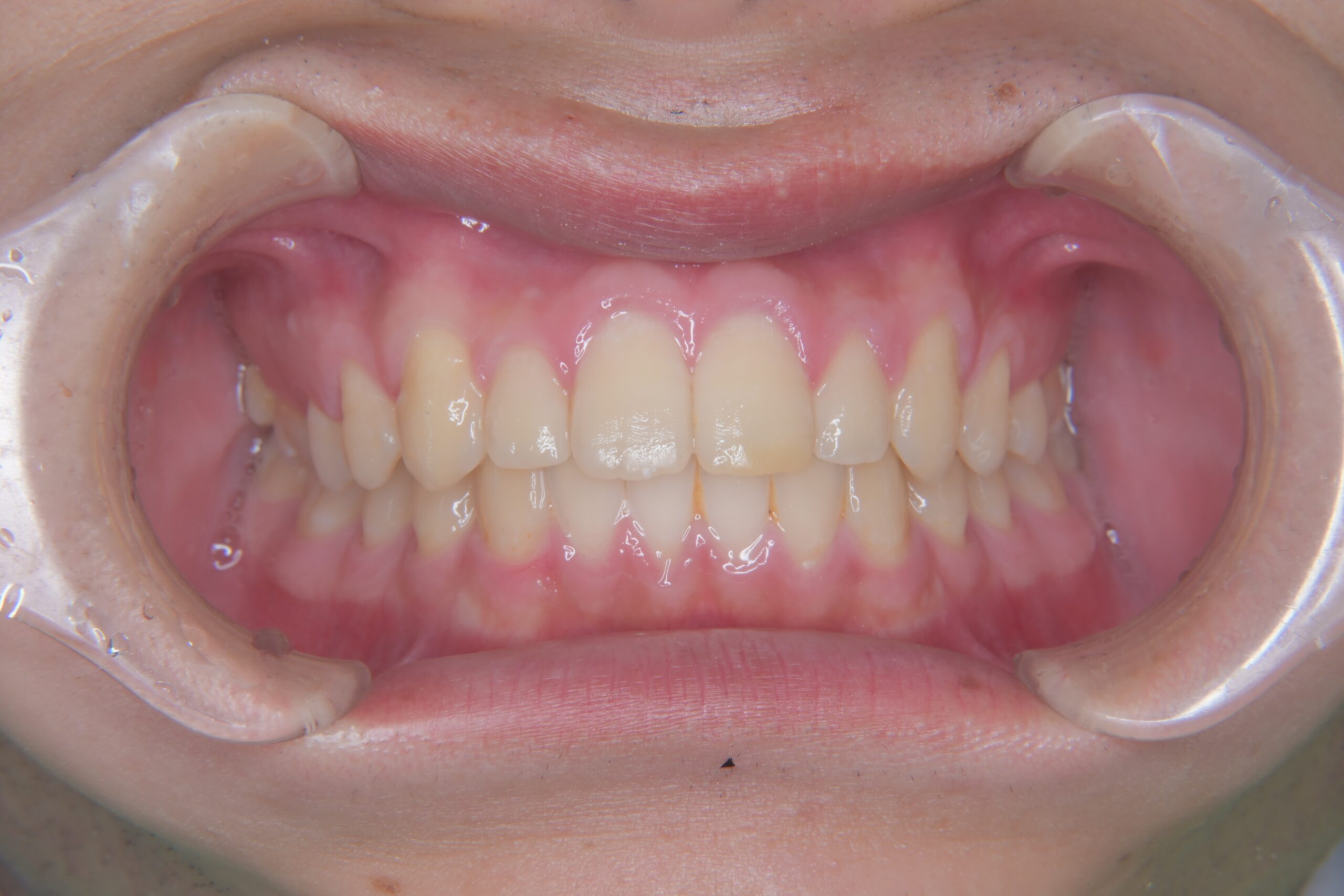 やまのうち歯科医院　宇都宮　歯医者　歯周病　インプラント　ホワイトニング　矯正　5