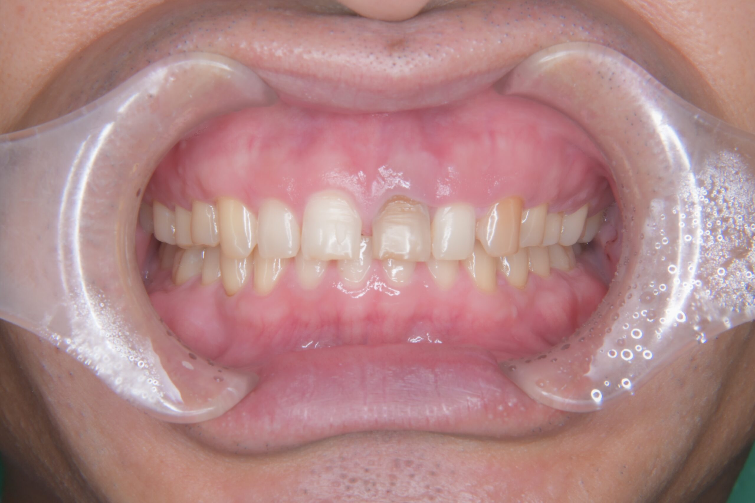 やまのうち歯科医院　宇都宮　歯医者　歯周病　インプラント　ホワイトニング　矯正　ラミネートべニア