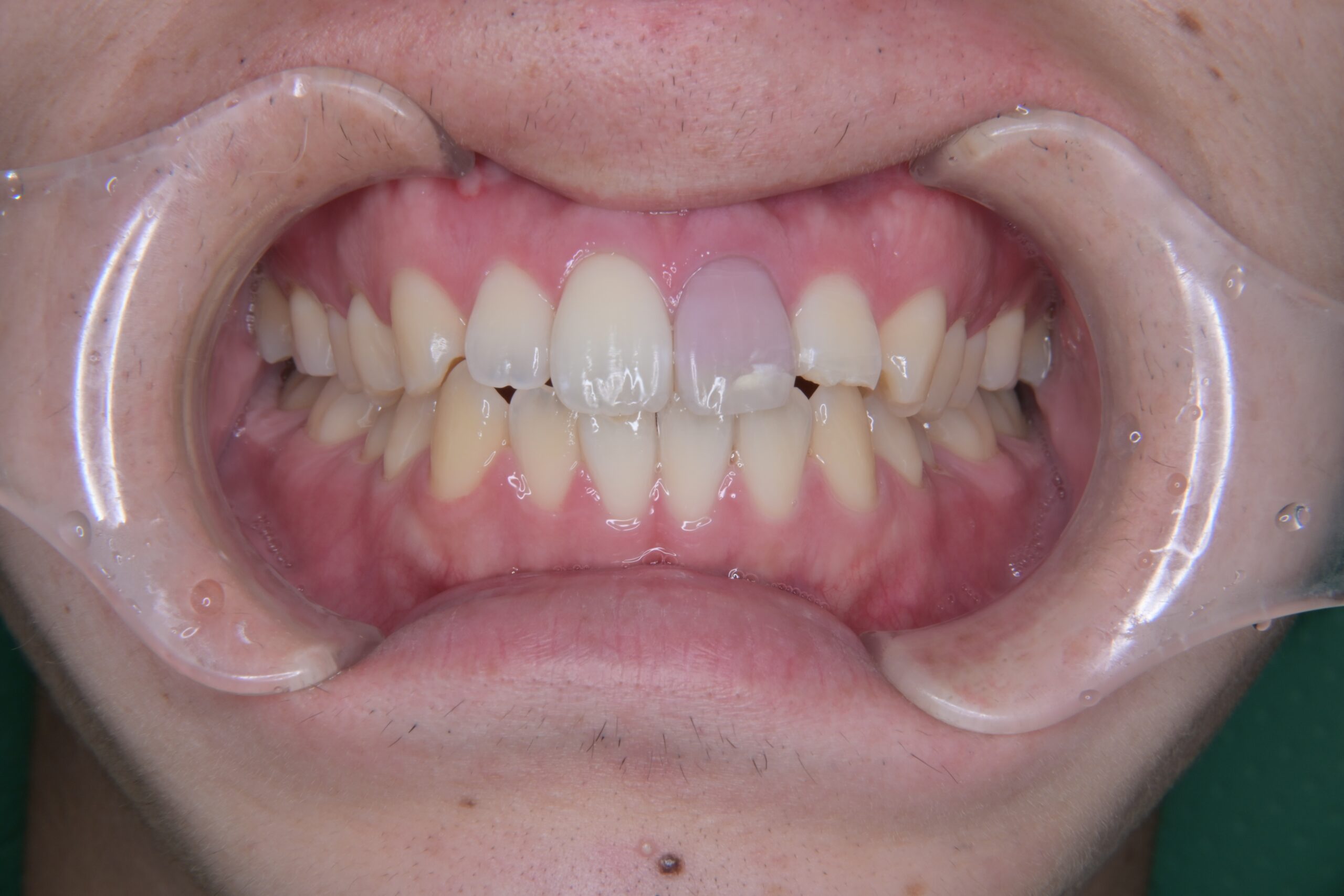 やまのうち歯科医院　宇都宮　歯医者　歯周病　インプラント　ホワイトニング　矯正　ラミネートべニア１