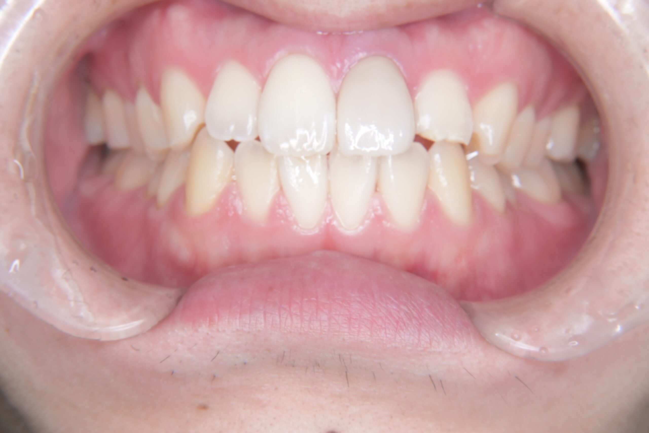 やまのうち歯科医院　宇都宮　歯医者　歯周病　インプラント　ホワイトニング　矯正　ラミネートべニア２