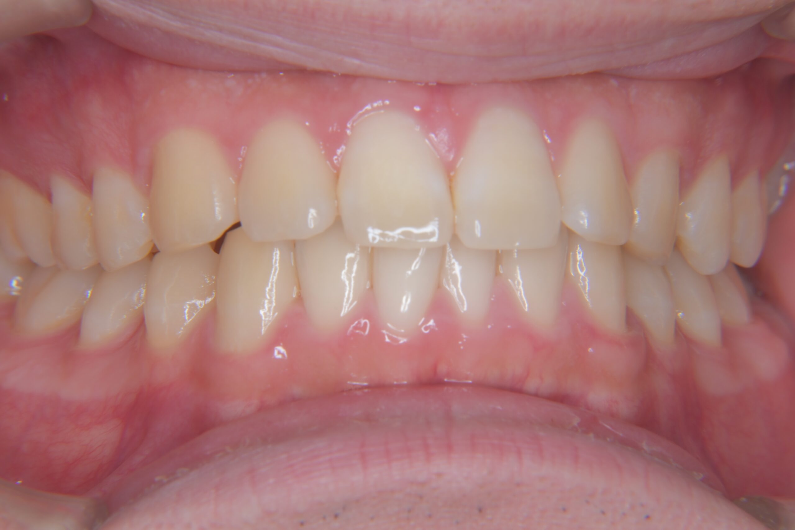 0000004915_やまのうち歯科医院　宇都宮　歯医者　歯周病　インプラント　ホワイトニング　矯正　入れ歯　マイクロスコープ　往診　宇都宮歯医者　歯磨き粉