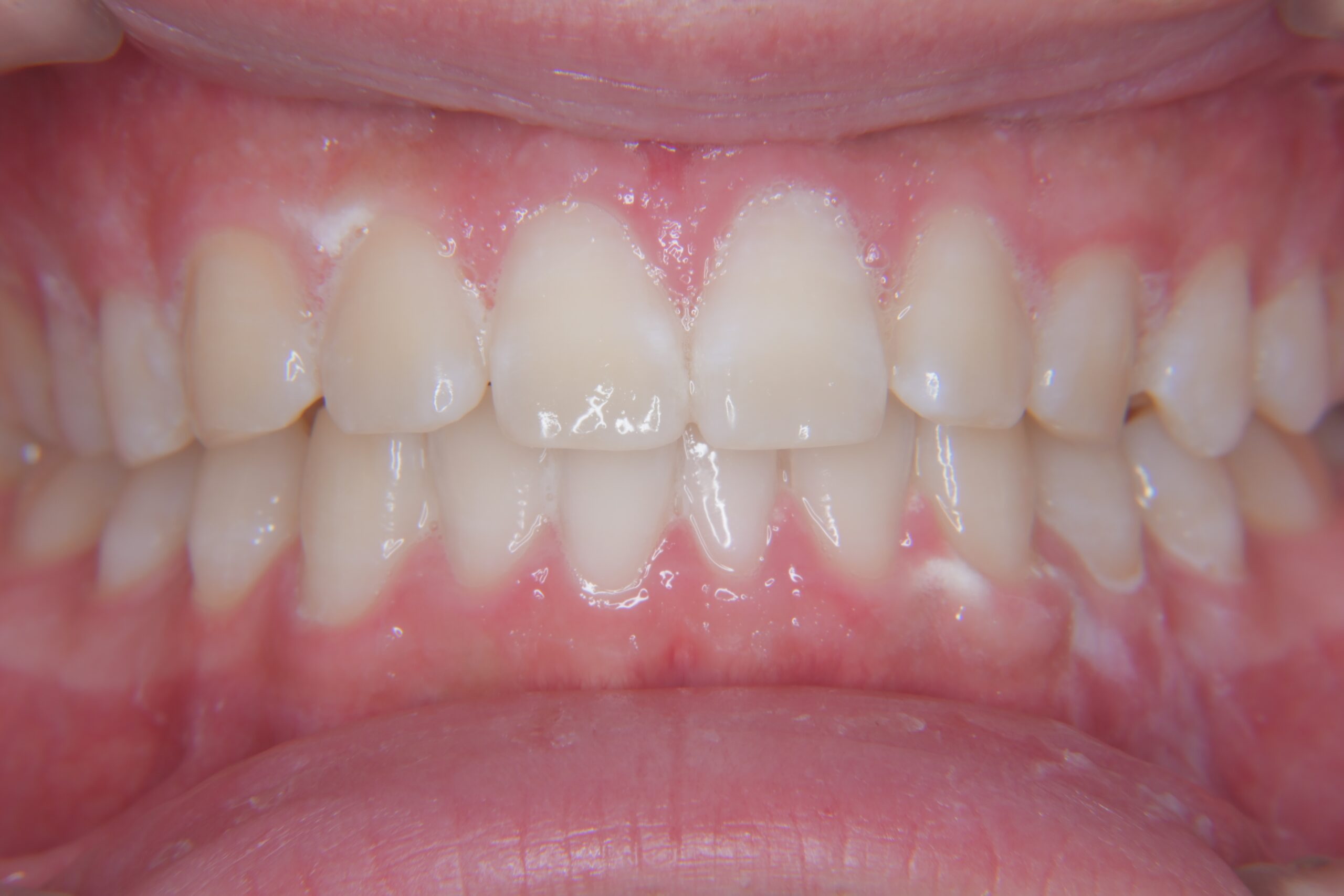 0000004915_やまのうち歯科医院　宇都宮　歯医者　歯周病　インプラント　ホワイトニング　矯正　入れ歯　マイクロスコープ　往診　宇都宮歯医者　歯磨き粉2