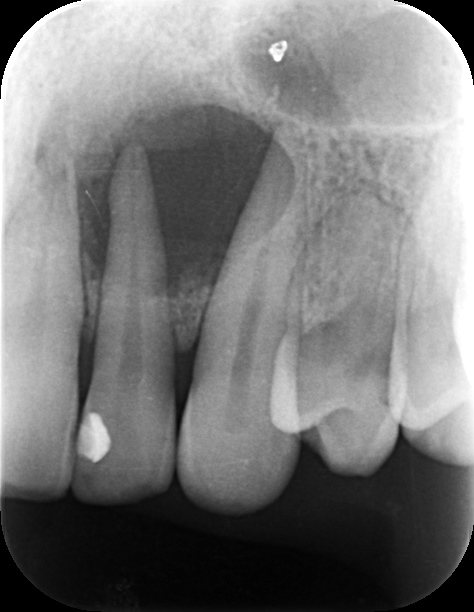 宇都宮　歯医者　むし歯　根の病気　歯周病　インプラント　やまのうち歯科医院　1