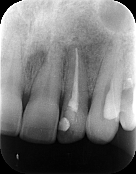 宇都宮　歯医者　むし歯　根の病気　歯周病　インプラント　やまのうち歯科医院　2