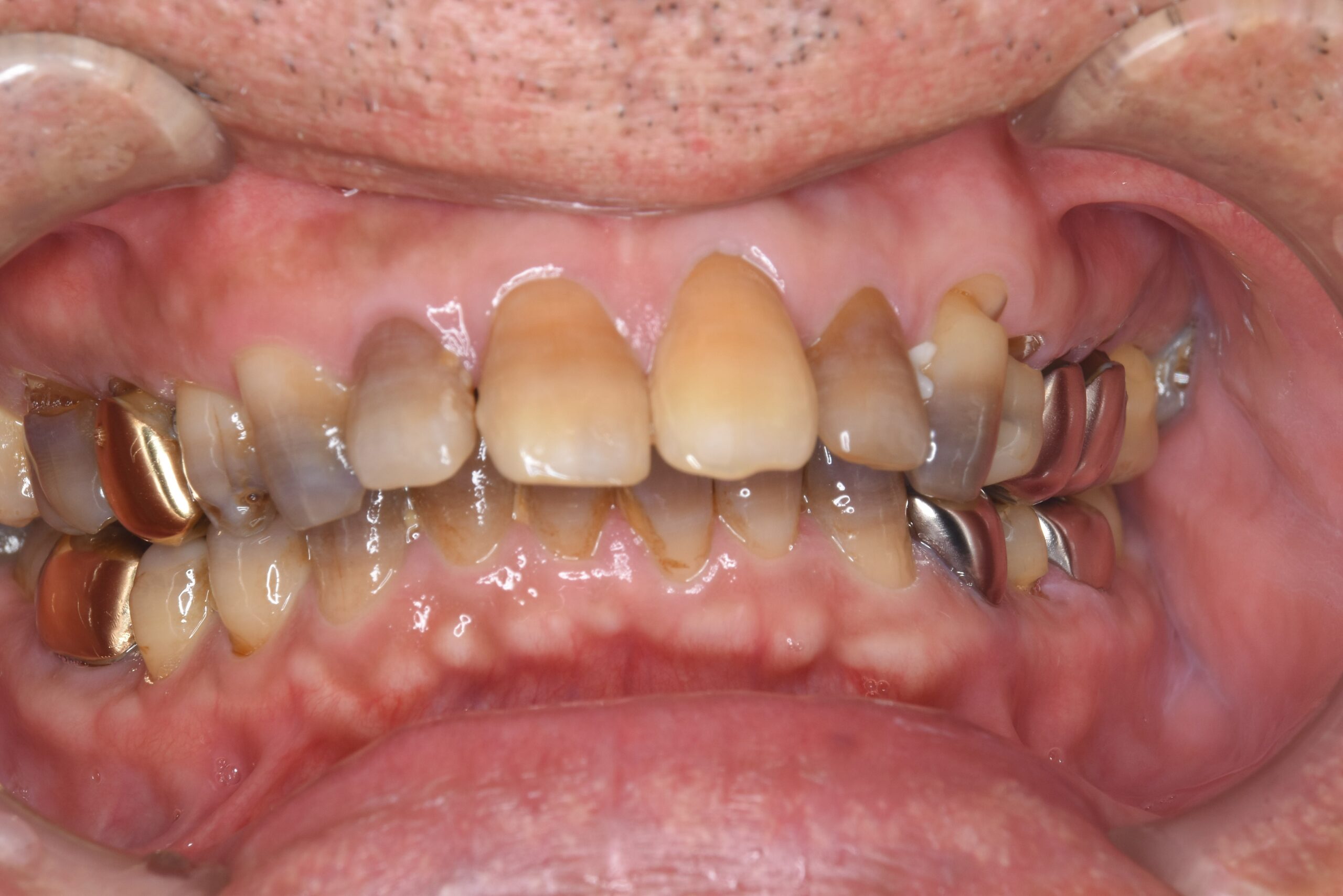 宇都宮　歯周病　やまのうち歯科医院　インプラント　歯医者　ラミネートべニア　ホワイトニング　2