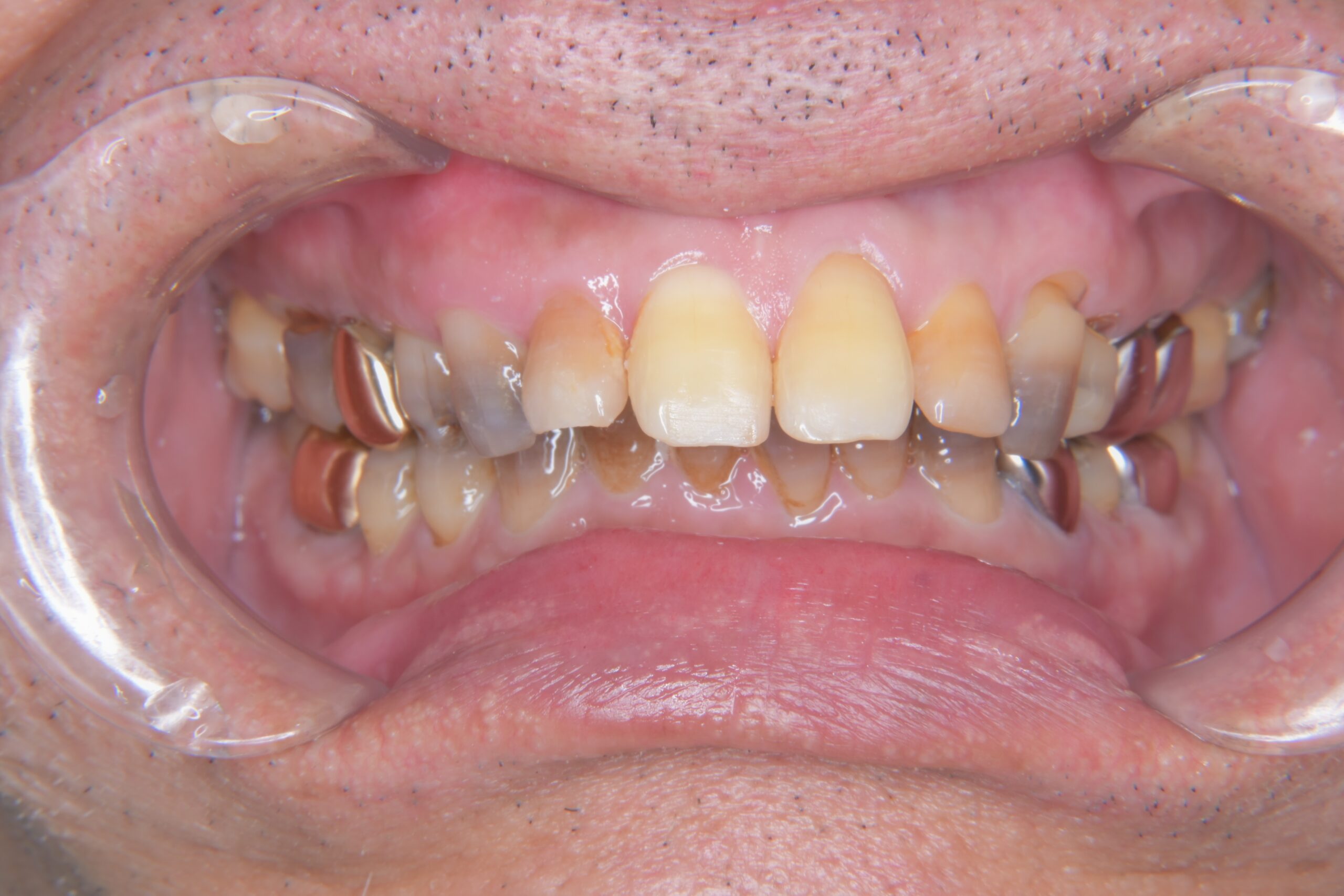 宇都宮　歯周病　やまのうち歯科医院　インプラント　歯医者　ラミネートべニア　ホワイトニング　3