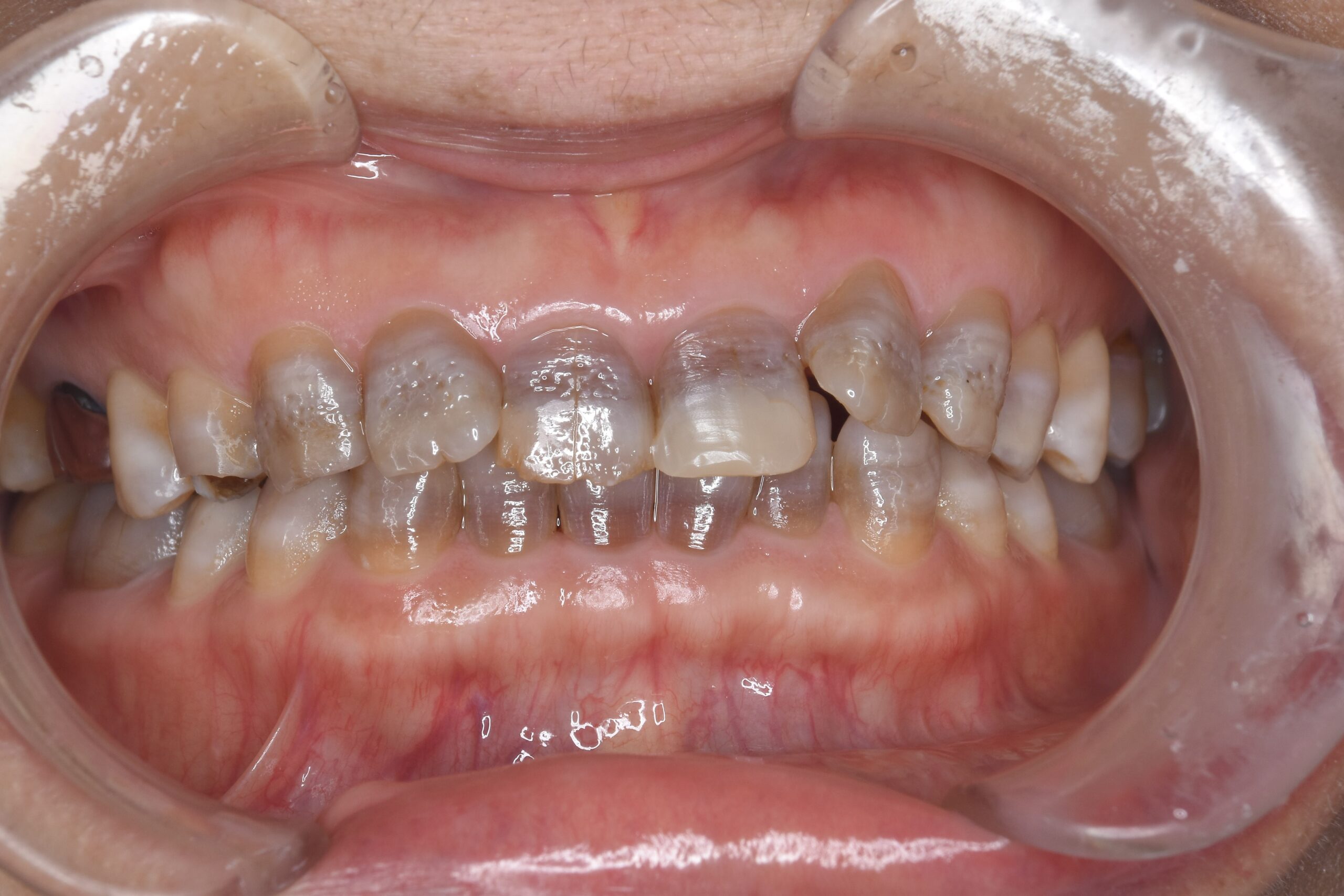 矯正　宇都宮　歯周病　インプラント　歯並び　抜歯　歯医者　求人　ホワイトニング　1