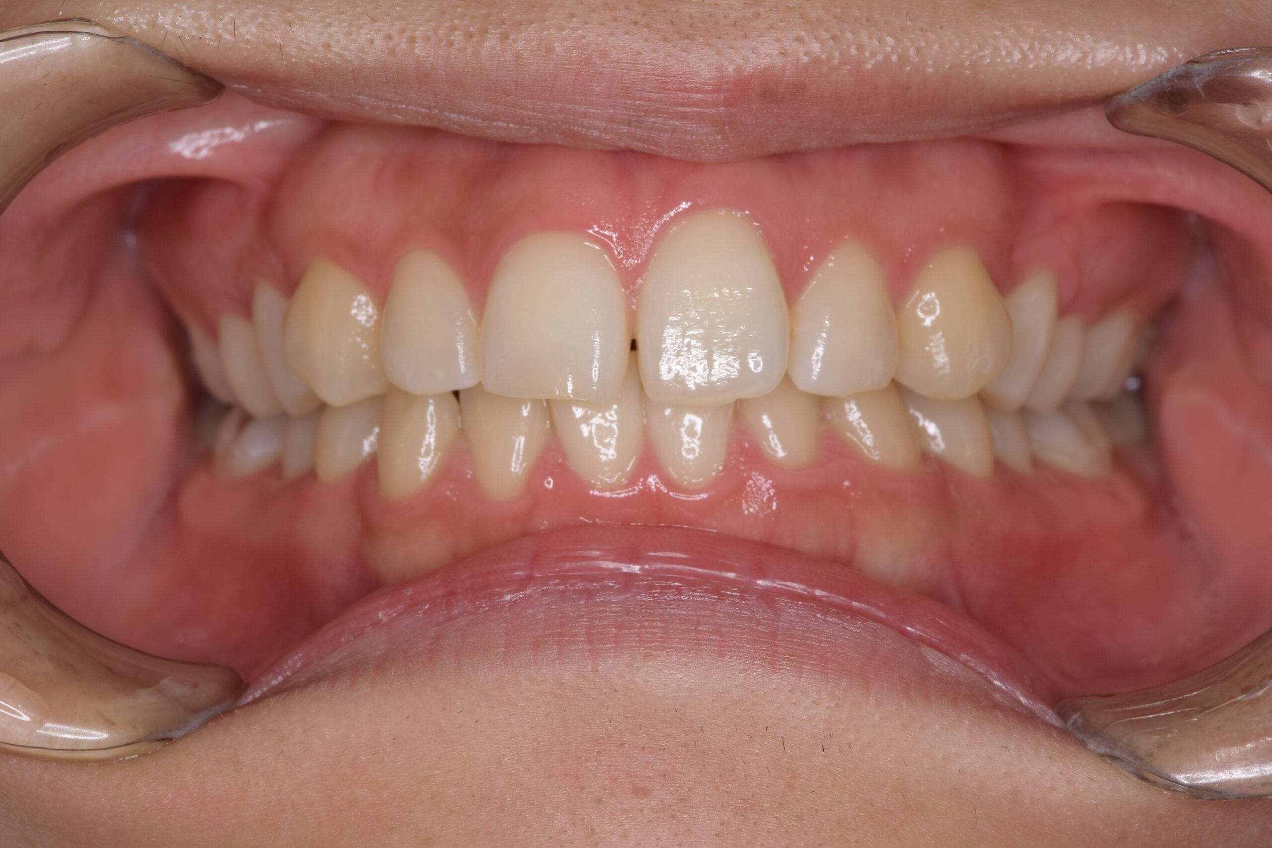 矯正　宇都宮　歯周病　インプラント　歯並び　抜歯　歯医者　求人　ホワイトニング　20