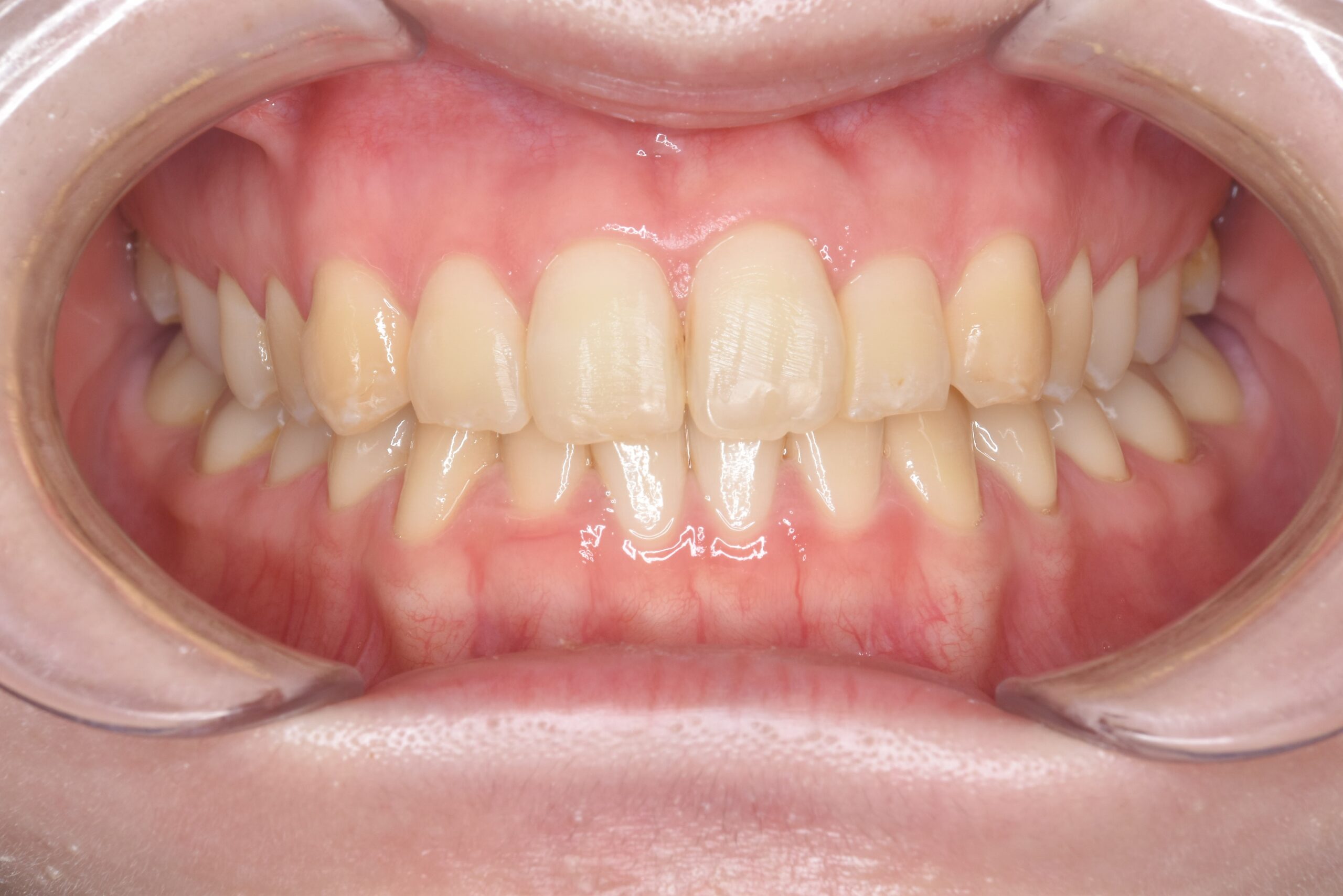 矯正　宇都宮　歯周病　インプラント　歯並び　抜歯　歯医者　求人　ホワイトニング　22