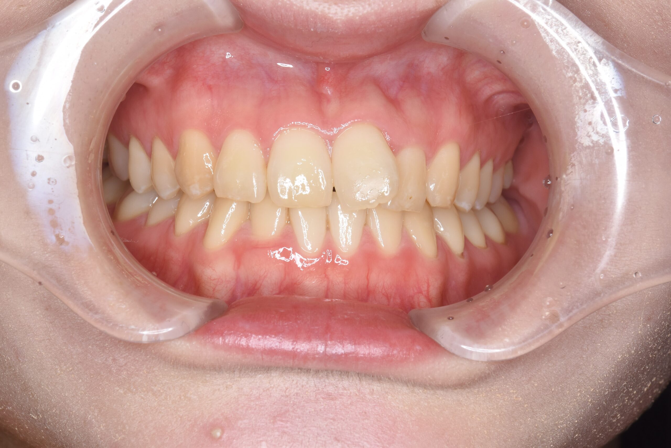 矯正　宇都宮　歯周病　インプラント　歯並び　抜歯　歯医者　求人　ホワイトニング　24