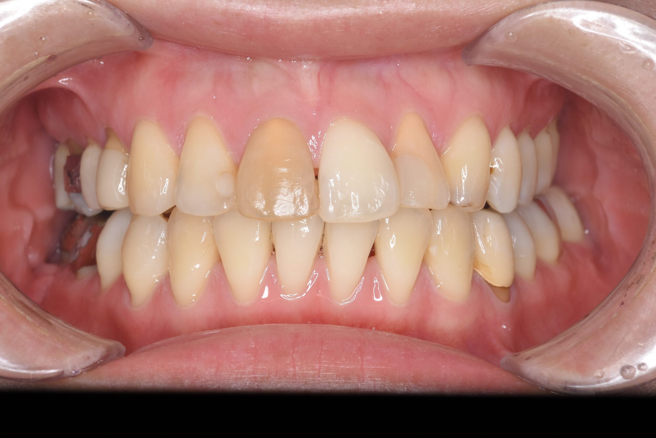 矯正　宇都宮　歯周病　インプラント　歯並び　抜歯　歯医者　求人　ホワイトニング　25