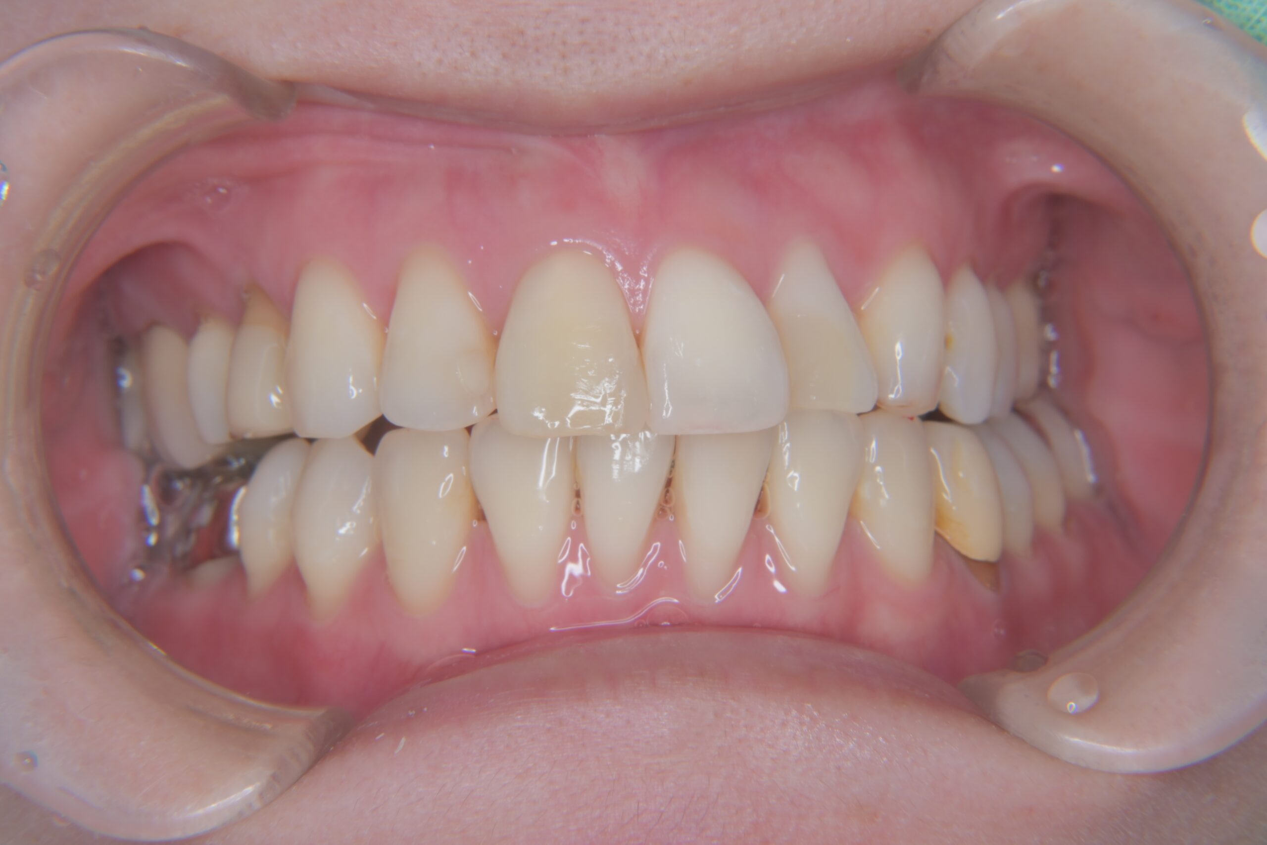 矯正　宇都宮　歯周病　インプラント　歯並び　抜歯　歯医者　求人　ホワイトニング　27