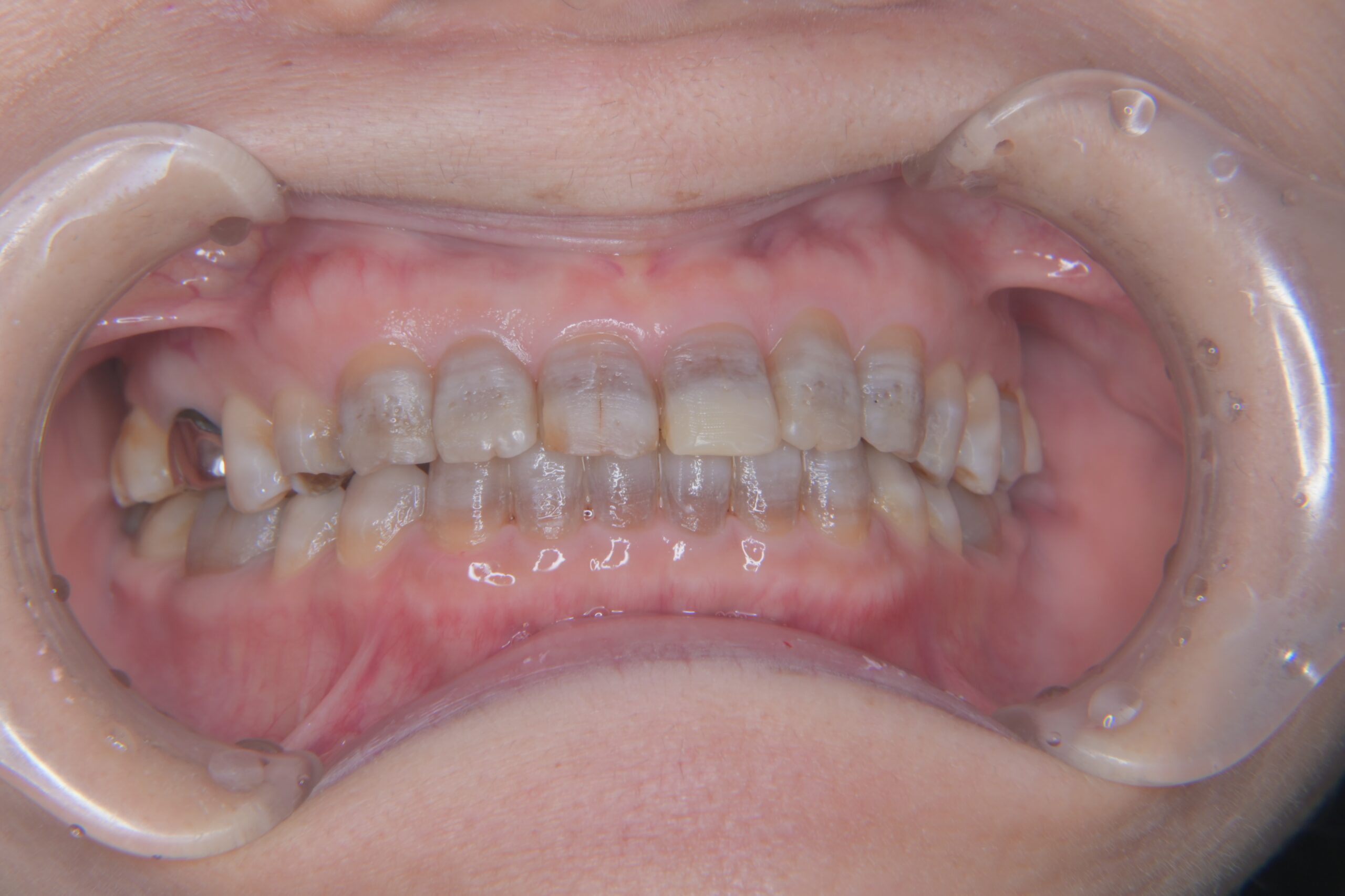 矯正　宇都宮　歯周病　インプラント　歯並び　抜歯　歯医者　求人　ホワイトニング　7