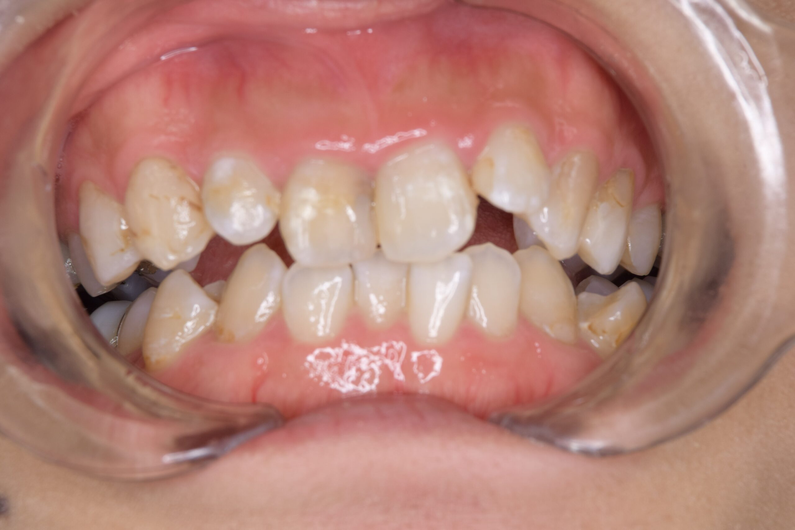 矯正　宇都宮　歯周病　インプラント　歯並び　抜歯　歯医者　求人　ホワイトニング　9