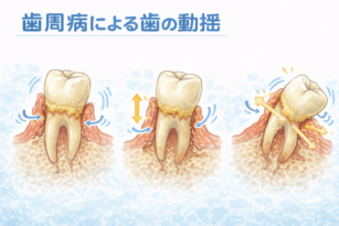 宇都宮　歯医者　歯周病　やまのうち歯科医院　歯周病　インプラント 診断