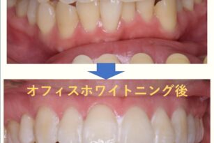 ホワイトニング