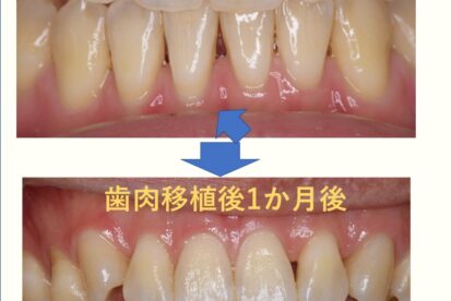 宇都宮　歯医者　歯周病　歯肉移植　